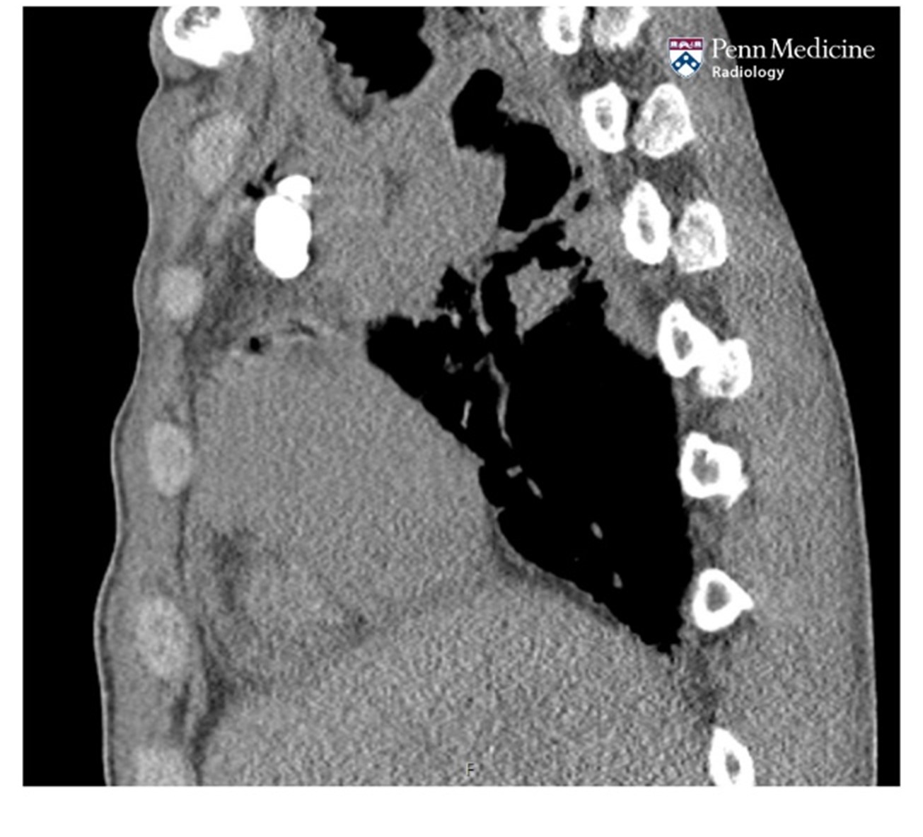 35-year-old man being evaluated prior to lung transplantation - Auntminnie