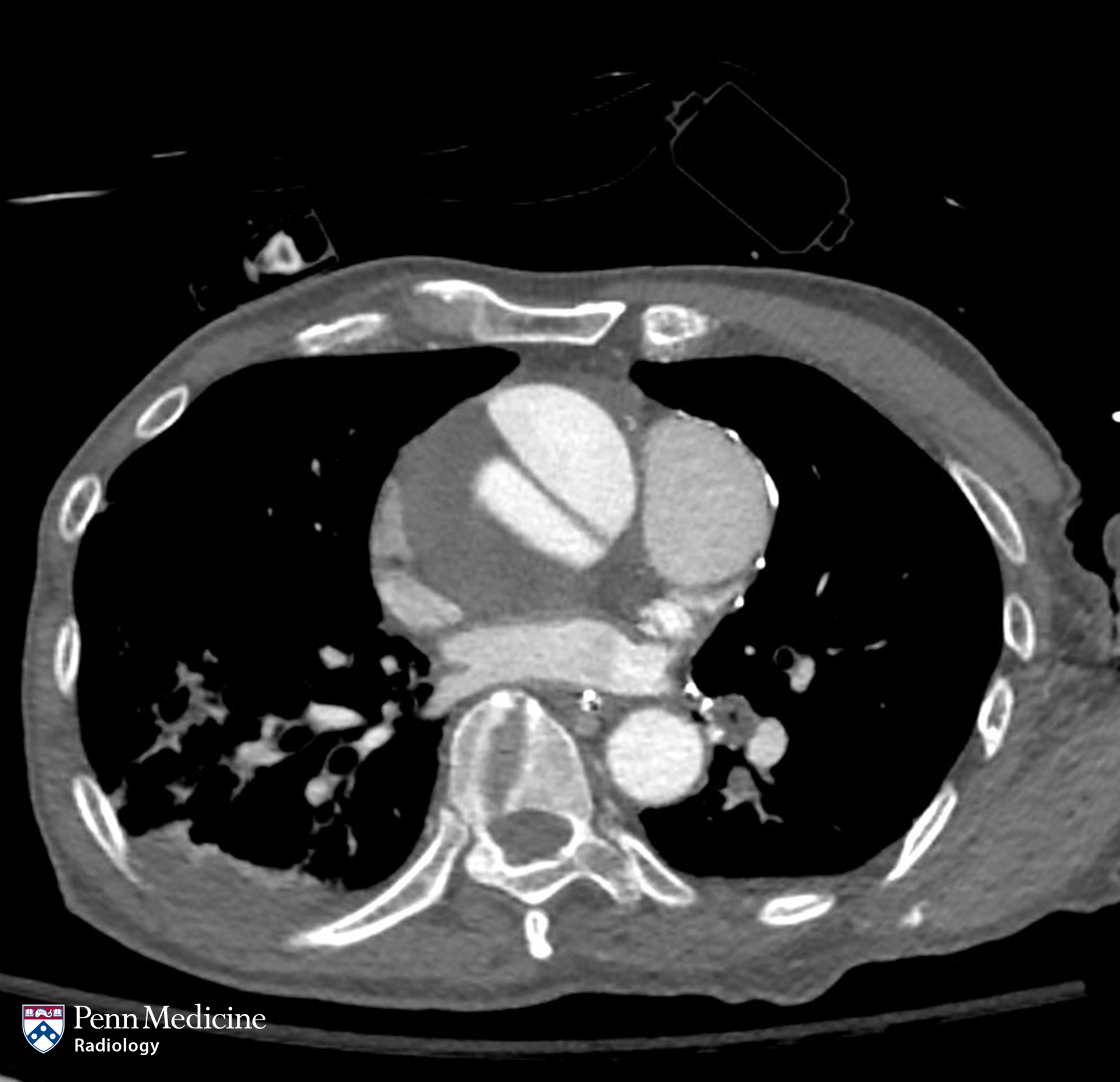 85-year-old man with acute chest pain - Auntminnie