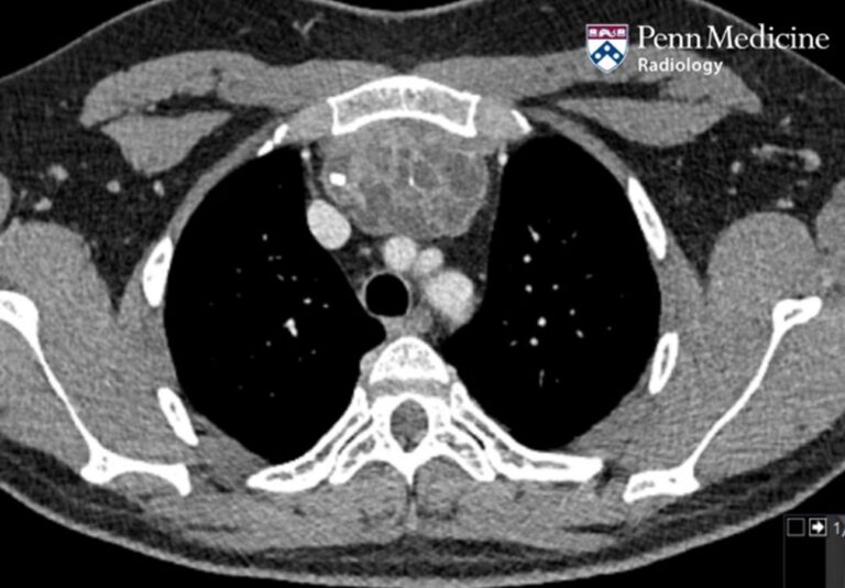 30 Year Old Man With Mediastinal Mass Auntminnie 1470