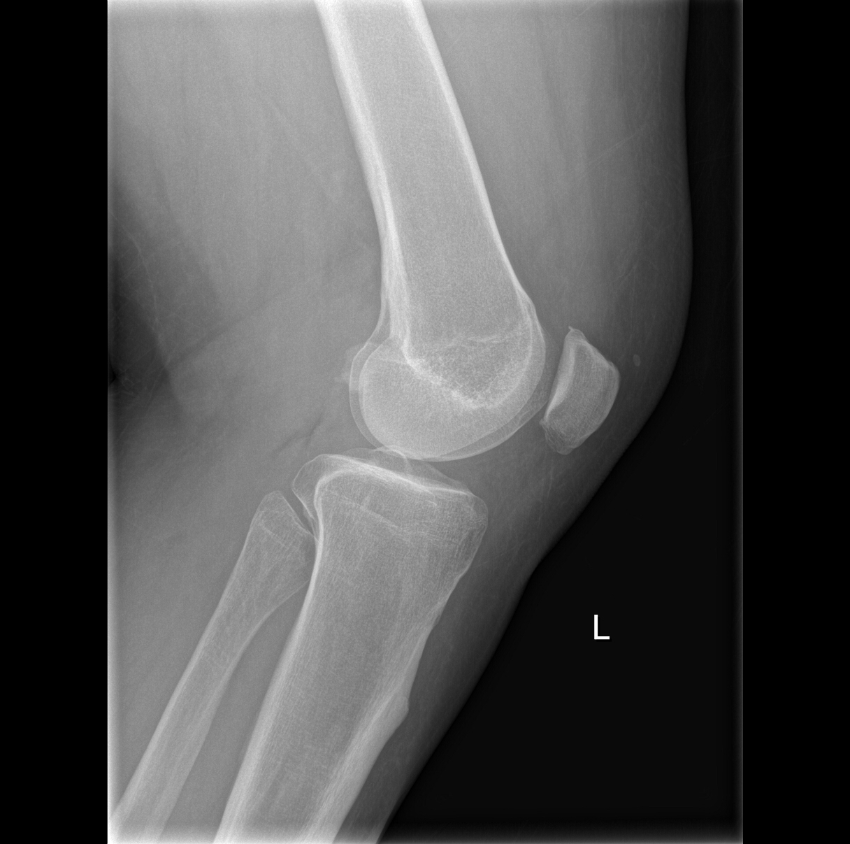 39-year-old man with acute left knee pain - Auntminnie