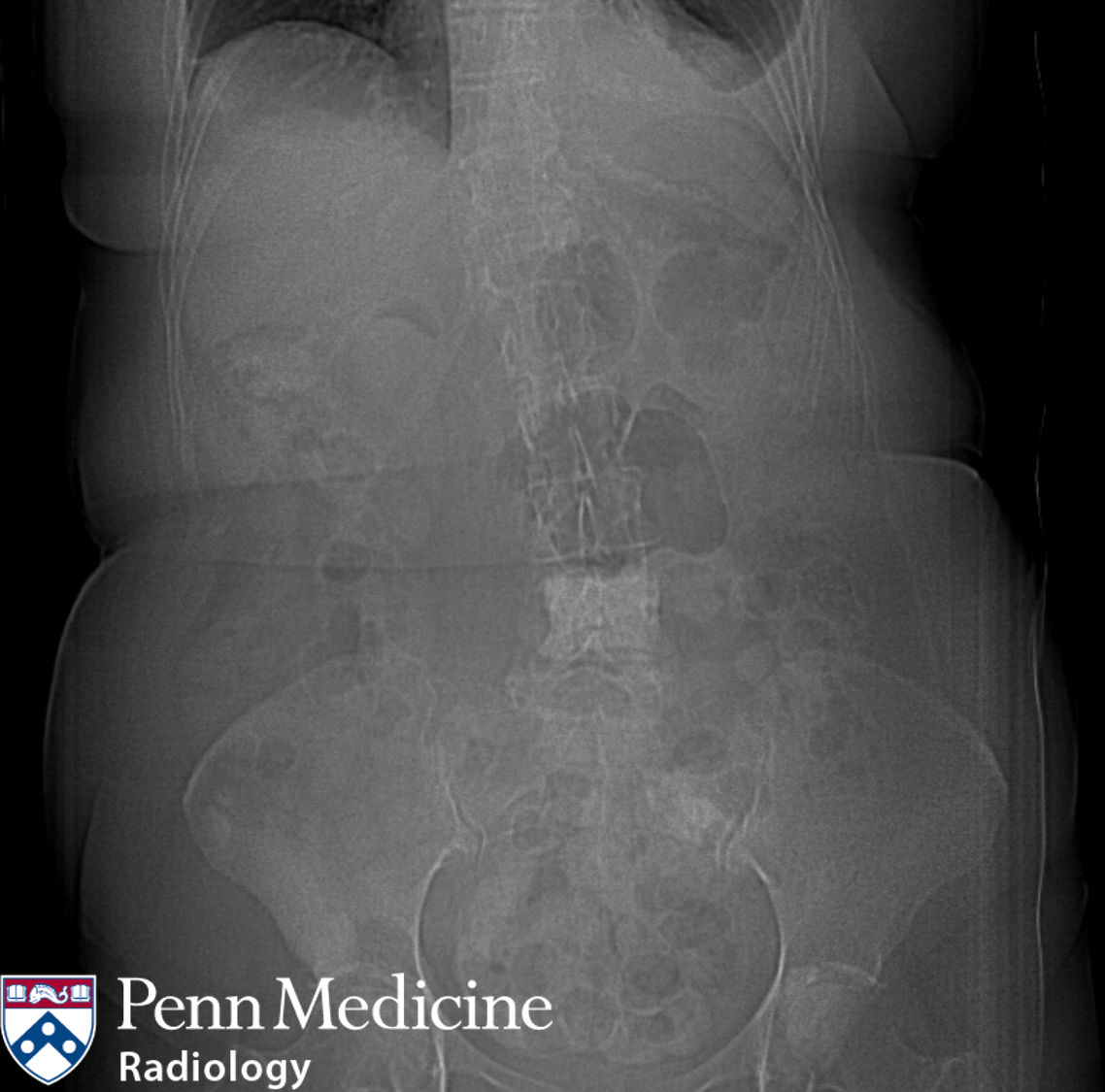 65-year-old-woman-with-abdominal-pain-auntminnie