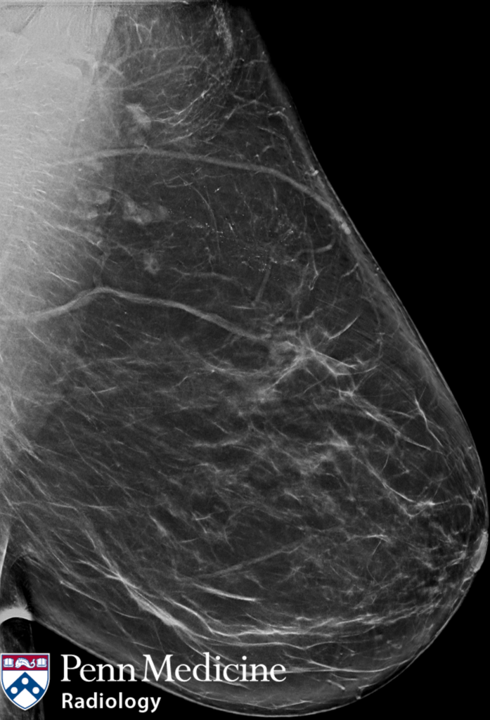 60-year-old-woman-undergoing-routine-screening-mammogram-auntminnie