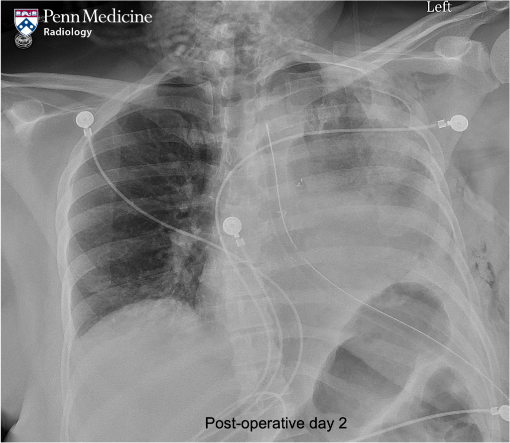 50-year-old-woman-after-left-upper-lobectomy-auntminnie