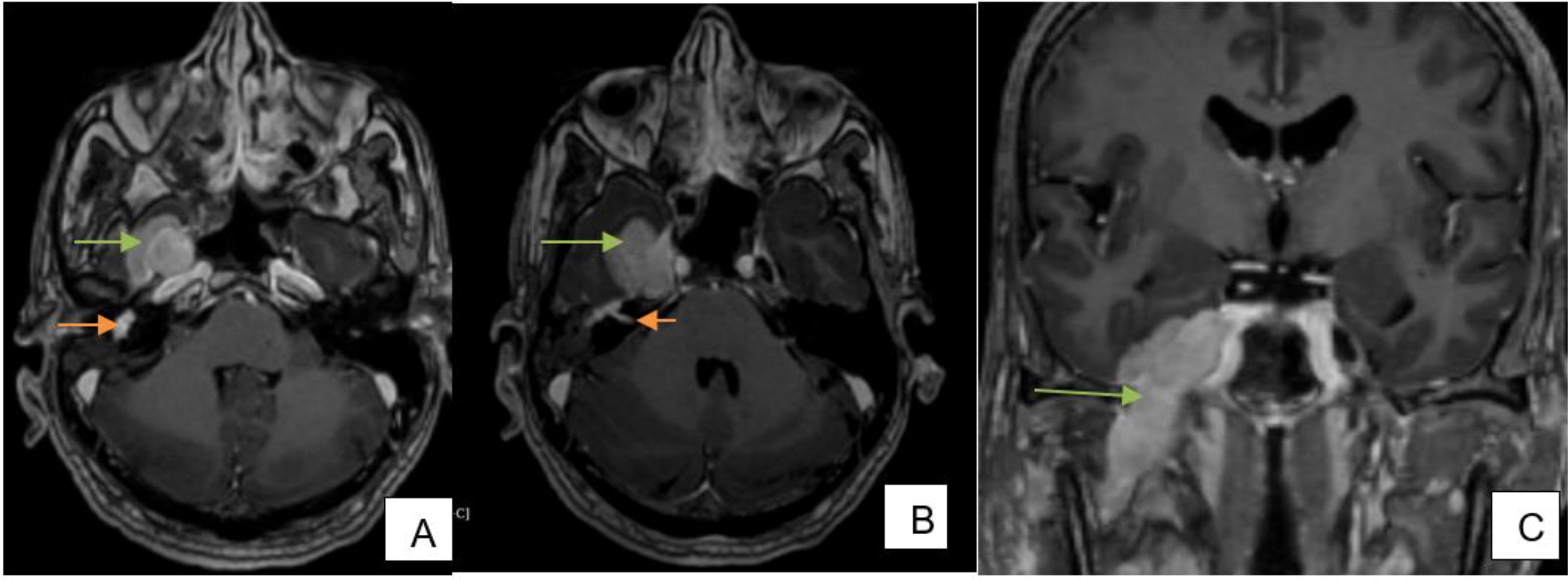 56 year old Man With Swelling Over Mandible Auntminnie