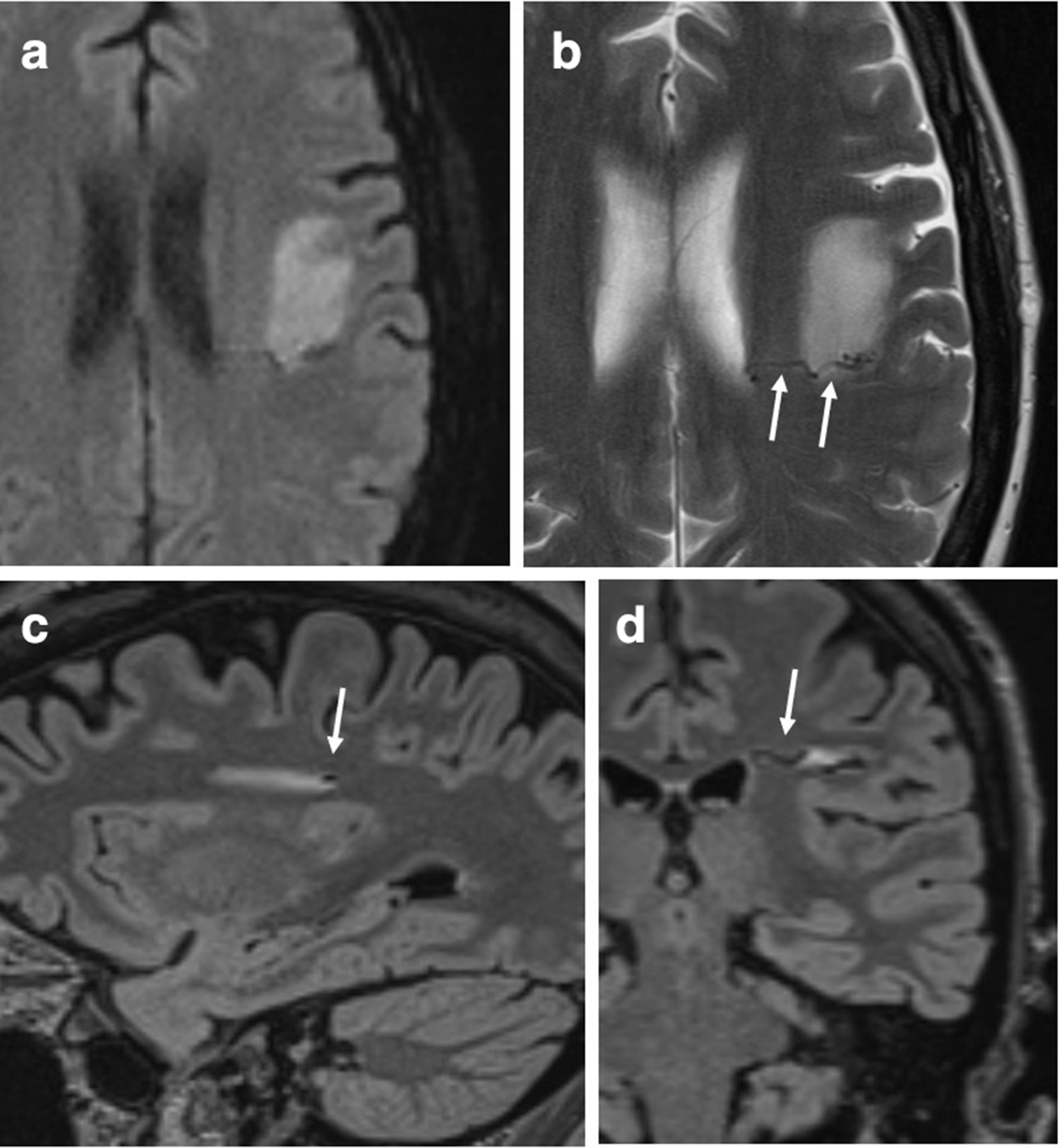 38 year old Woman With Liver Cirrhosis And Tonic clonic Seizure 
